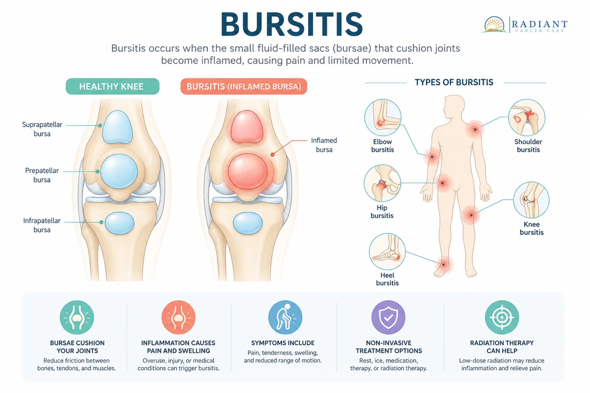 Bursitis.compressed Bursitis.compressed