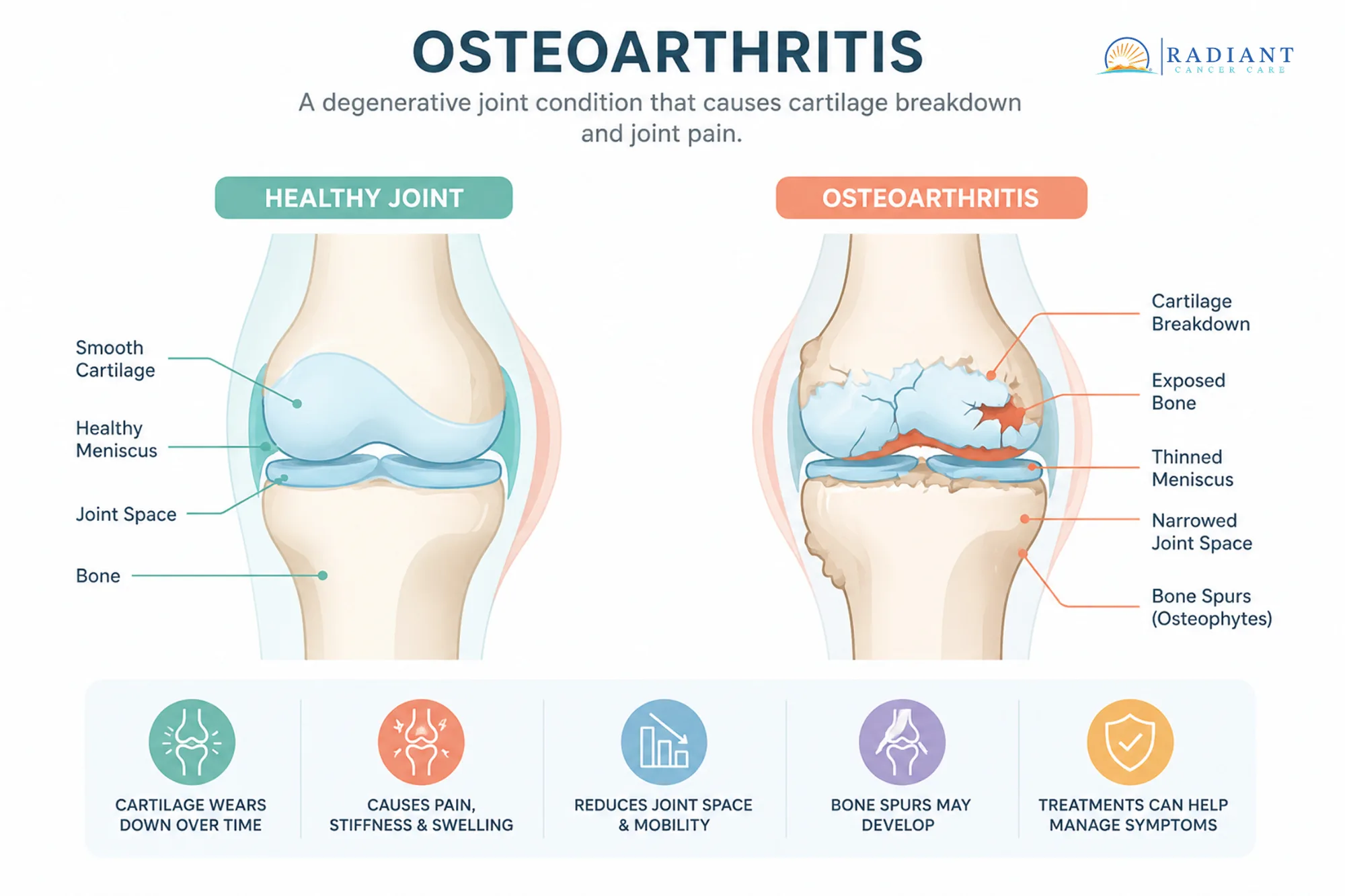 Osteoarthritis Osteoarthritis is a degenerative joint condition that causes cartilage breakdown, leading to pain, stiffness, and reduced mobility..compressed Osteoarthritis Osteoarthritis is a degenerative joint condition that causes cartilage breakdown, leading to pain, stiffness, and reduced mobility..compressed